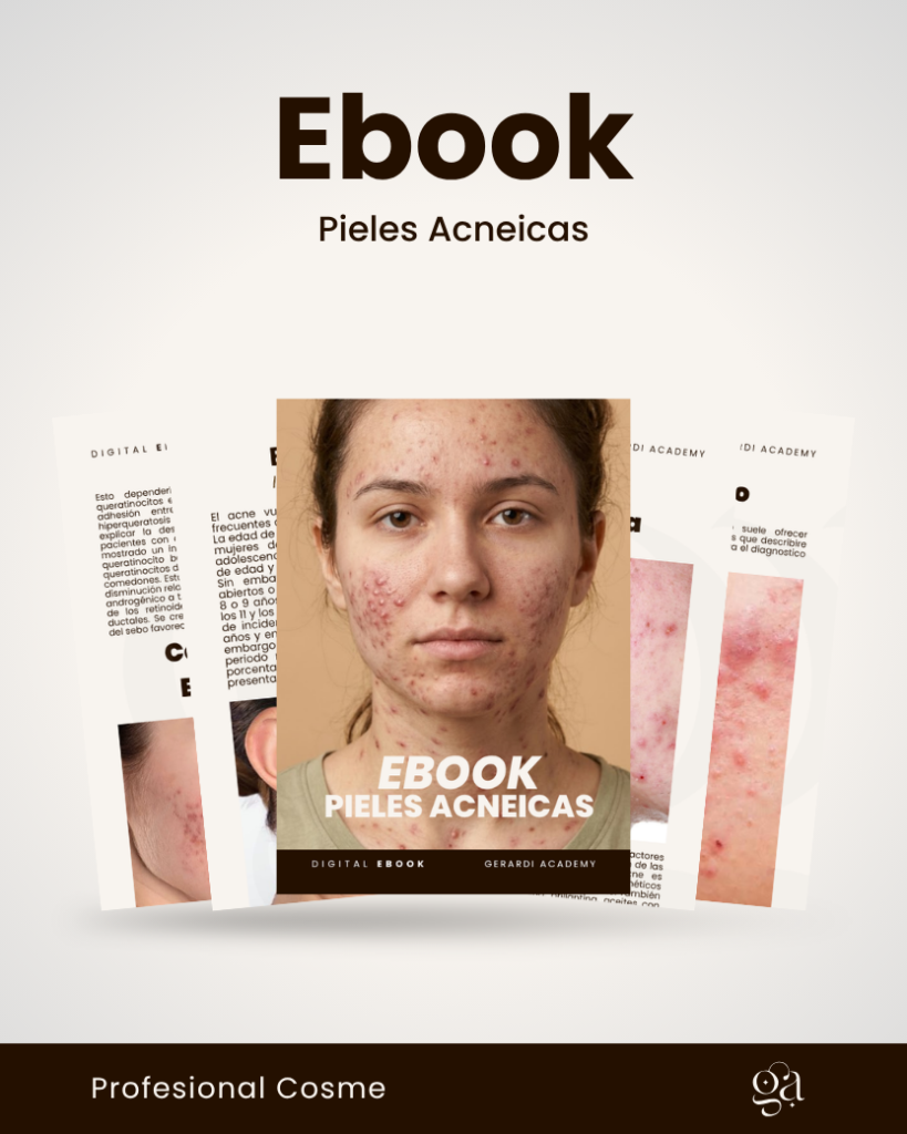 EBOOK DE ACNE